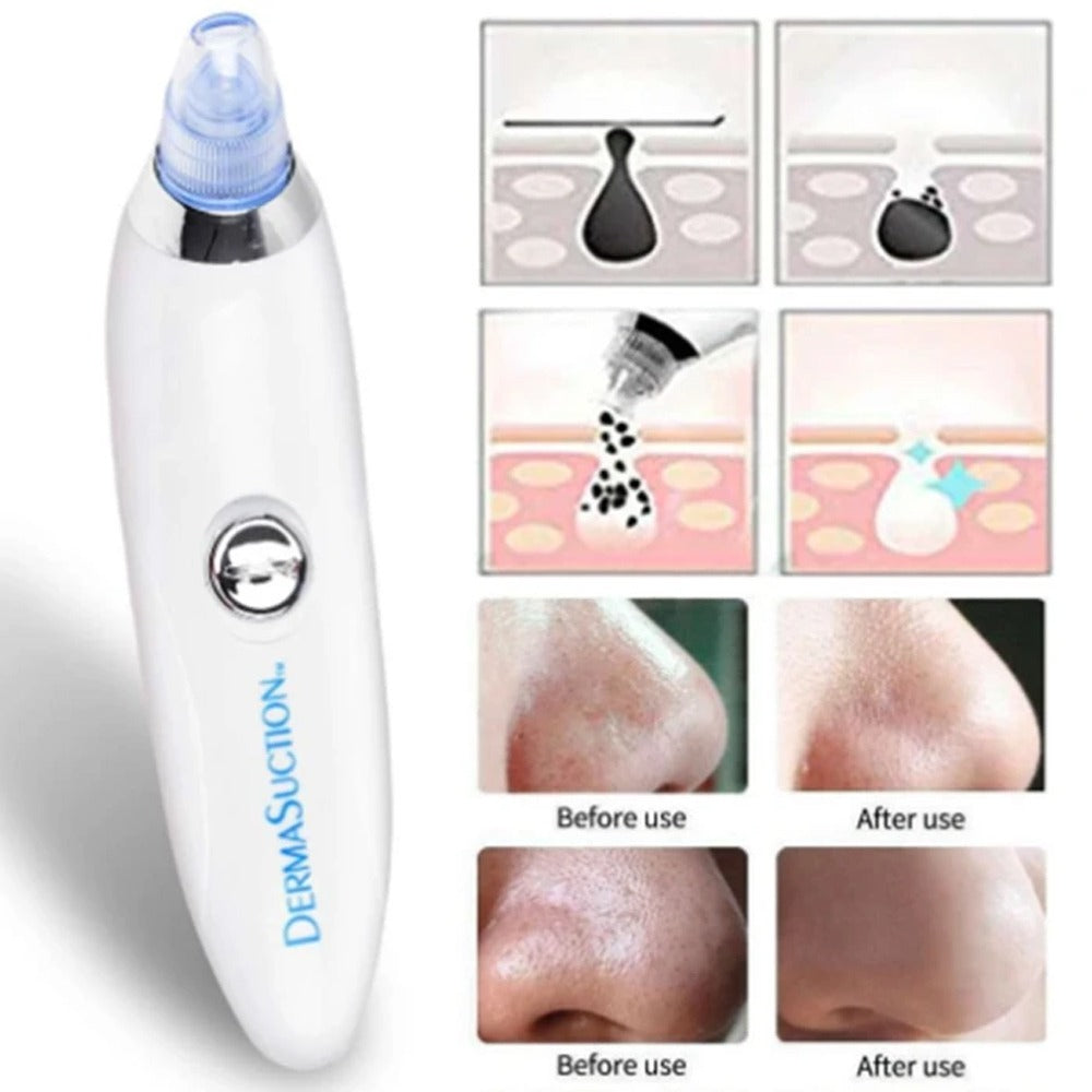 4 in 1 Rechargeable Blackhead Removal Machine – Face Acne Pore Cleaner Vacuum Suction Tool Decent Vibes