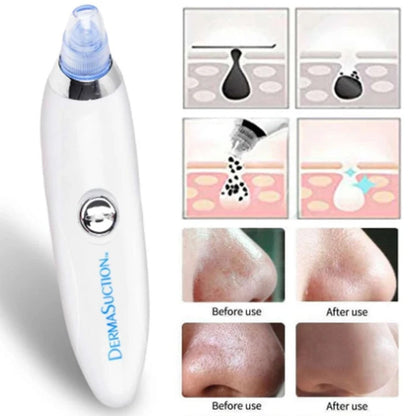 4 in 1 Rechargeable Blackhead Removal Machine – Face Acne Pore Cleaner Vacuum Suction Tool Decent Vibes