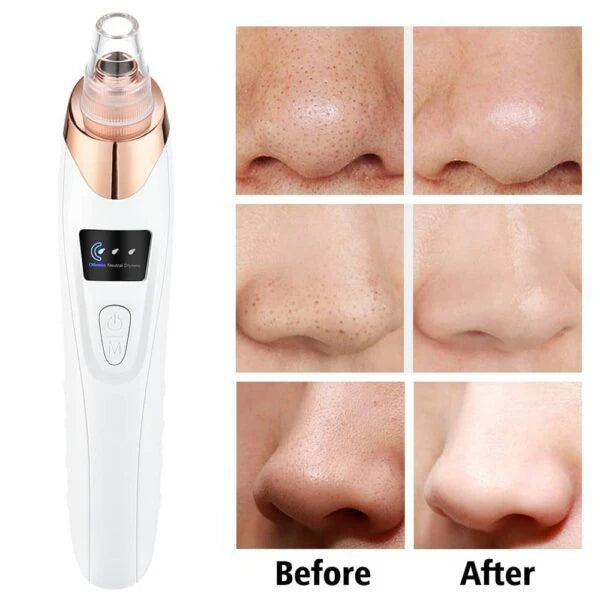 Face Vacuum Suction Blackhead Remover – Electric Deep Cleansing Pore Cleaner Decent Vibes